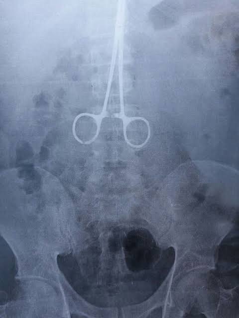 Mulher denúncia negligência após material cirúrgico ter sido esquecido em sua barriga na Paraíba