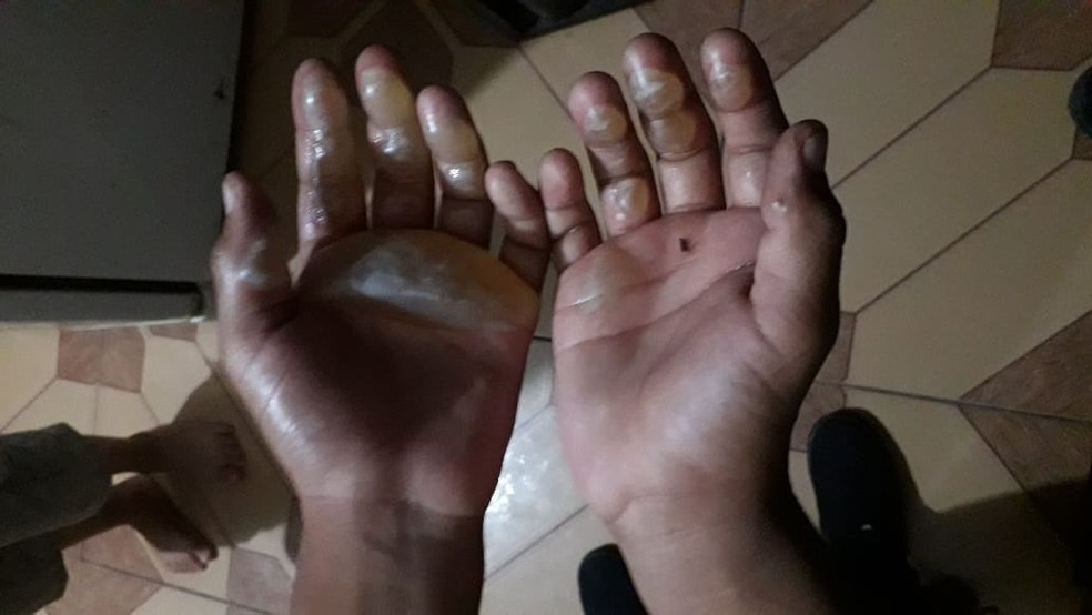 Mãe é acusada de queimar a mão do filho por ele pegar algo que não deveria