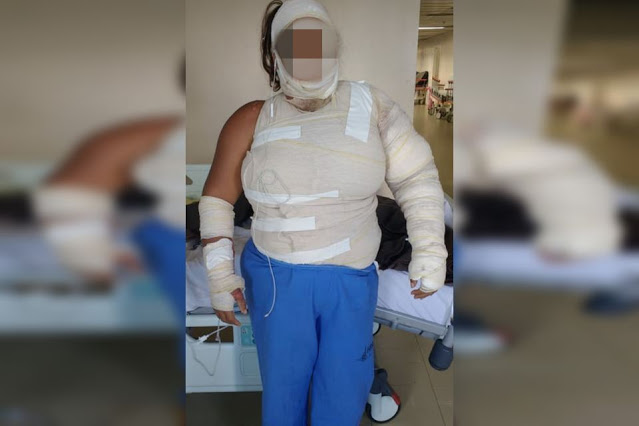‘Vou te queimar’, diz homem antes de cumprir ameaça e atear fogo em mulher