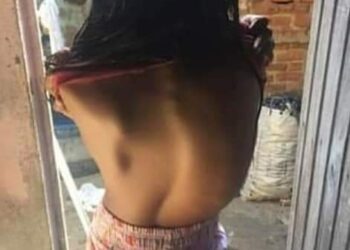 Família pede ajuda para criança que tem problema grave na coluna