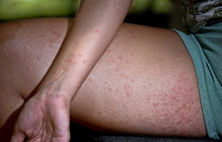 Confirmados casos da ‘coceira misteriosa’ em Serra, Triunfo e Floresta. Em Afogados, autoridades não confirmam nenhum caso.