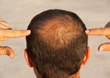 Pesquisa aponta remédios mais eficazes contra a calvície; veja resultado