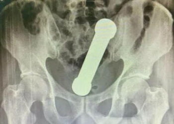 Médicos removem haltere de 2kg do ânus de homem em Manaus; veja fotos