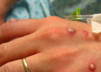 Anvisa sugere máscara e isolamento para adiar chegada de varíola do macaco ao Brasil