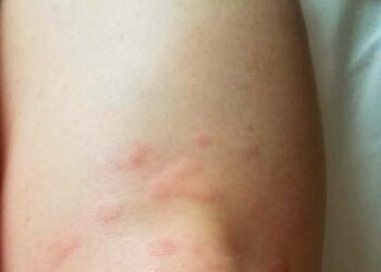 Mulher desenvolve urticária e coceira persistentes após tomar vacina contra a Covid