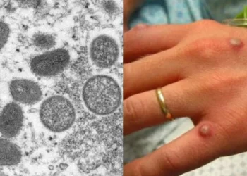 Varíola dos macacos: OMS diz estar preocupada com a disseminação da doença entre as crianças