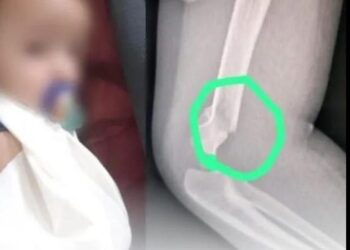 Bebê é agredido por professora, tem braço quebrado e precisa passar por cirurgia