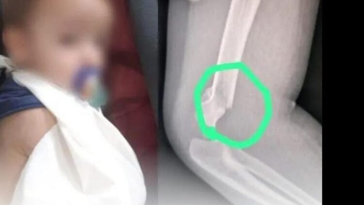 Bebê é agredido por professora, tem braço quebrado e precisa passar por cirurgia