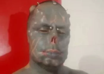 Diabão faz unificação de dedos e transforma mão em “garra”