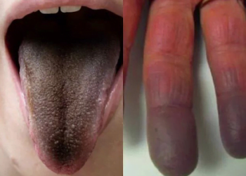 Língua peluda e dedo roxo: saiba mais sobre os novos sintomas da Covid-19