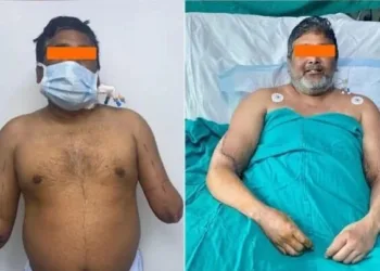 Indiano recupera as 2 mãos após fazer transplante de alta complexidade
