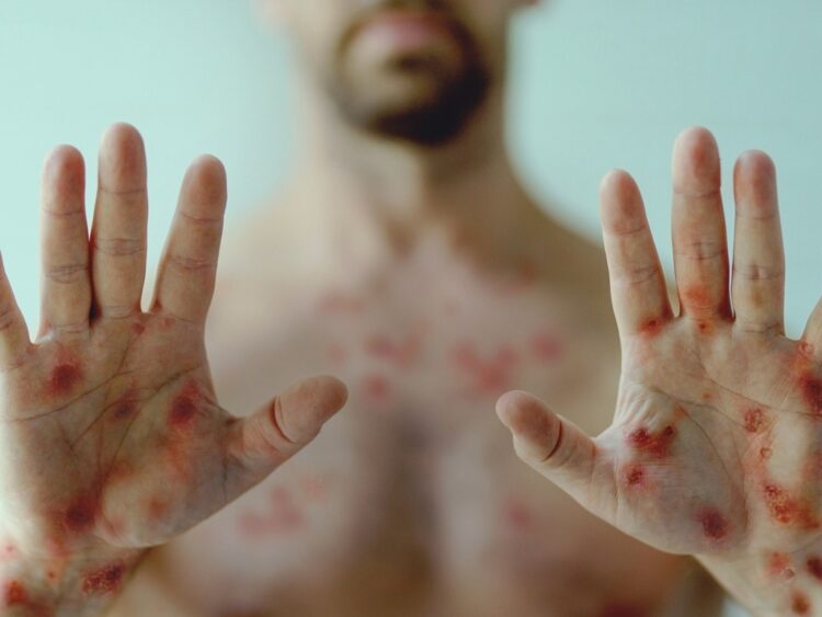 OMS declara mpox como emergência em saúde pública global