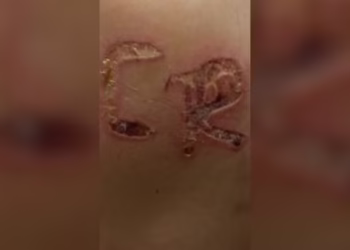 Marido é preso após marcar iniciais do nome dele no corpo da esposa