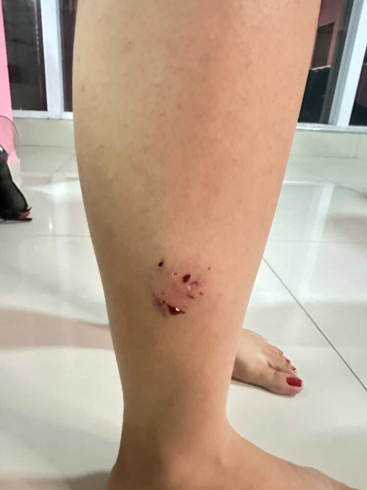 Mulher é atacada por cachorro de rua em Afogados da Ingazeira