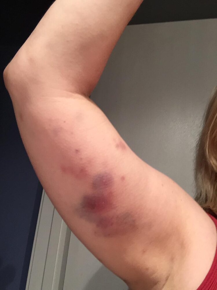 Em Serra Talhada, homem embriagado ataca companheira com mordidas após briga por quantia irrisória