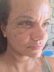 Mulher que levou 61 socos mostra rosto em recuperação