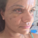 Mulher que levou 61 socos mostra rosto em recuperação