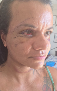 Mulher que levou 61 socos mostra rosto em recuperação