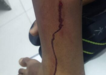 Jovem é atacado por cachorro na Praça de Alimentação de Afogados da Ingazeira