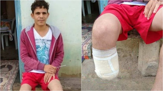 Homem corta próprio pé para receber seguro de R$ 1,5 milhão, mas acaba condenado; Entenda a história